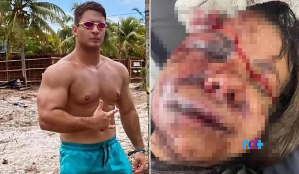 Mulher espancada por ex-jogador de basquete teve rosto desfigurado